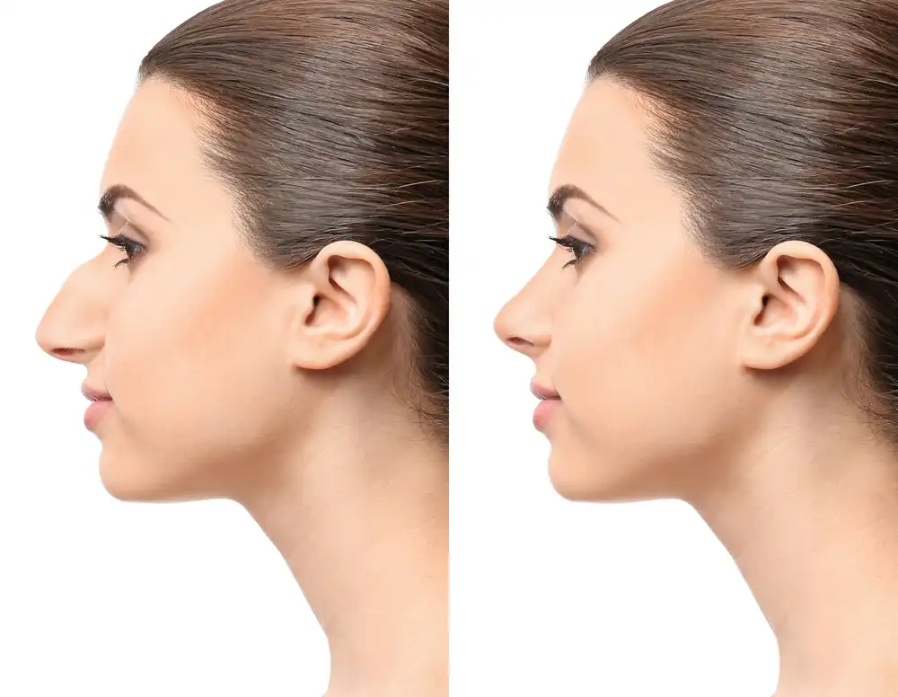 Tip Plasty Procedure